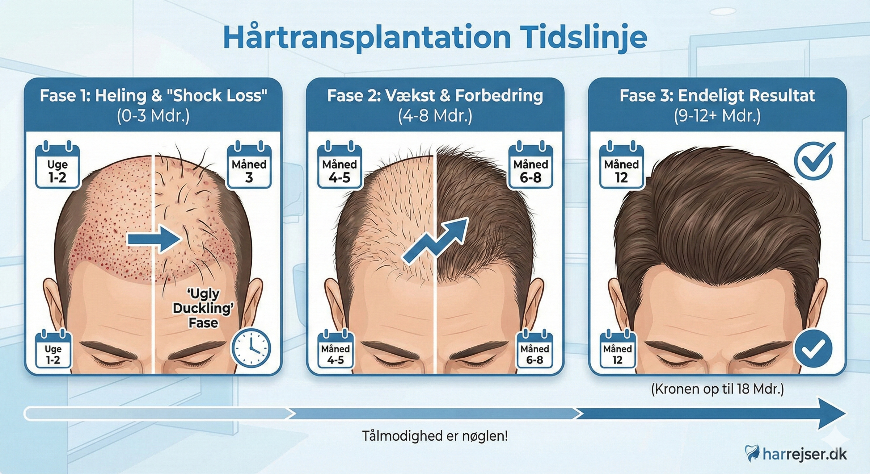 Hårtransplantation Tidslinje: Resultater Måned for Måned